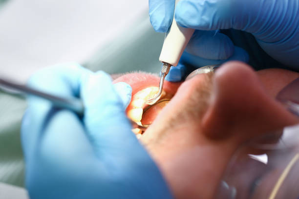 Best Emergency Wisdom Tooth Extraction in Dudley, NC